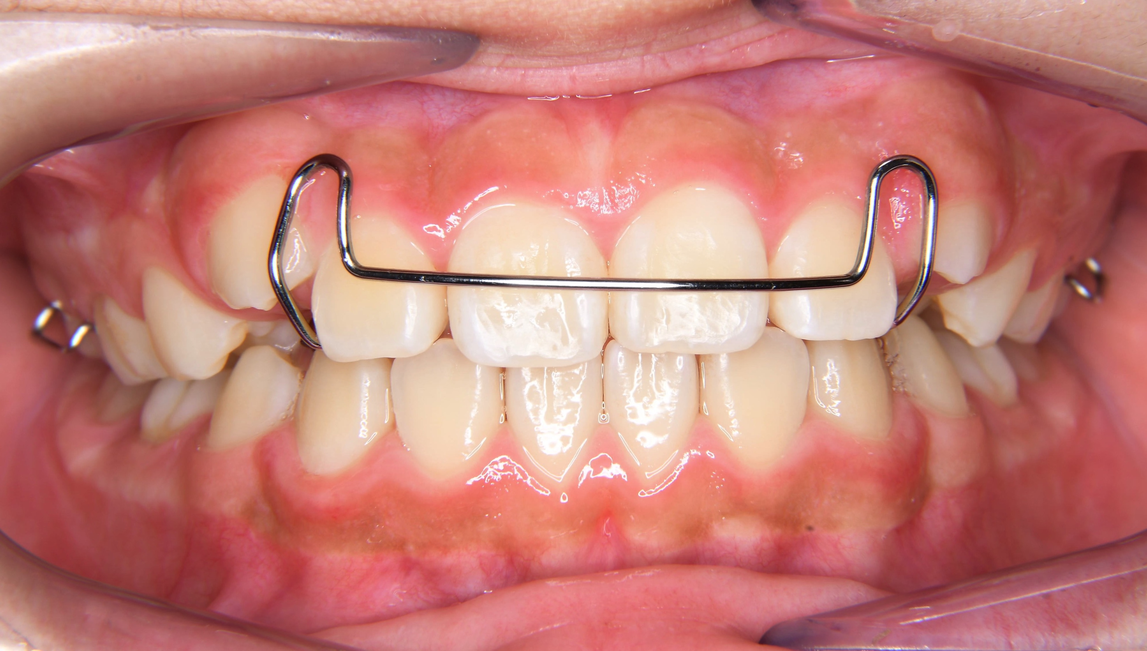 混合歯列期の治療 | ひたちの矯正歯科